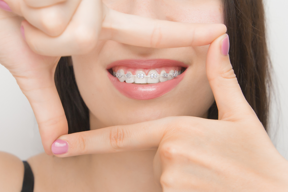 when to consider braces in Grafton