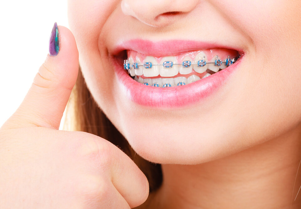 how to keep your teeth white when you have braces