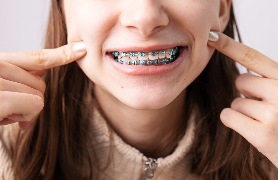 Keeping Your Gums Healthy While Wearing Braces