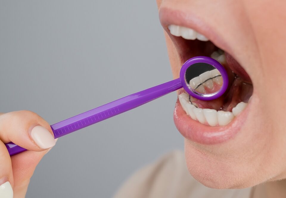 Why Retainers Matter: The Truth About Lifelong Retention