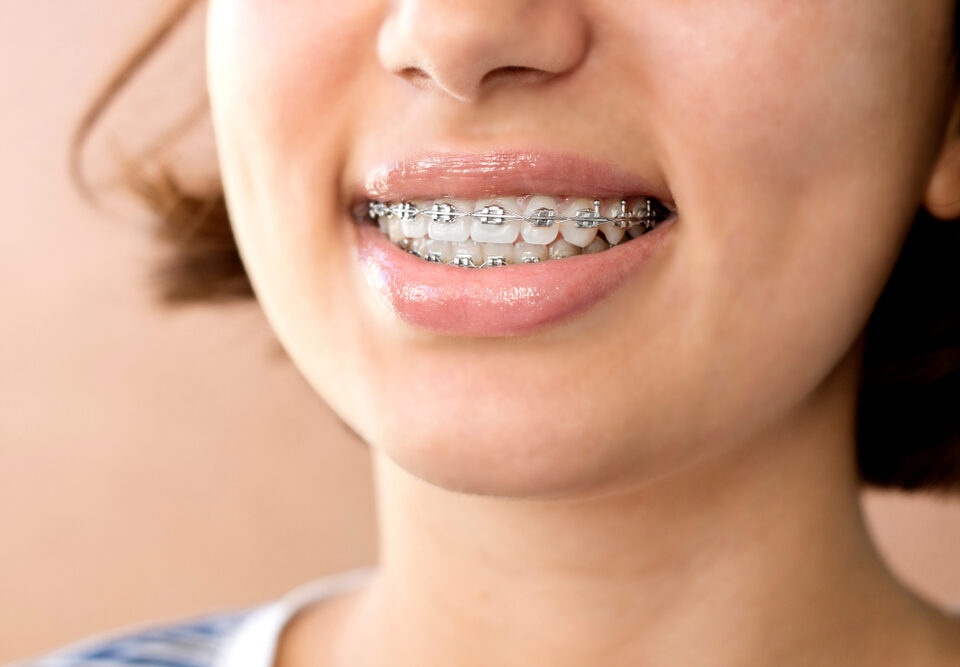 How Long Does Orthodontic Treatment Take?