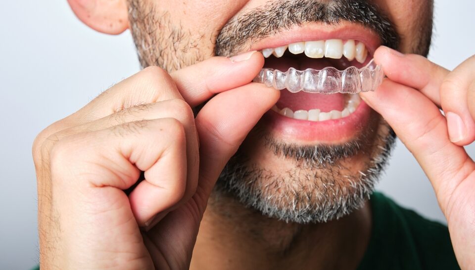 Clear Aligners: A Comfortable, Discreet Way to Transform Your Smile